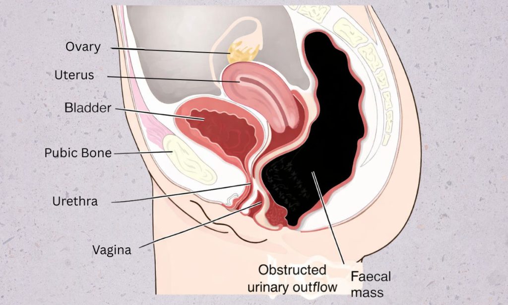 Image showing fecal impaction compressing bladder and obstructing urinary outflow in female pelvis